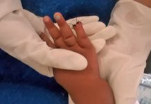 Bebê tem dedo amputado acidentalmente por enfermeira